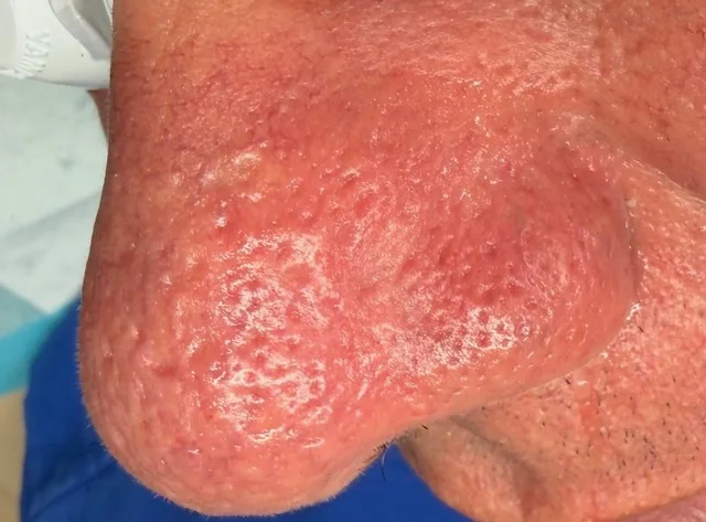 Facial Telangiectasis Treatment after treatment