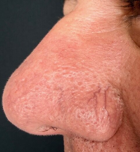 Facial Vein Removal before treatment