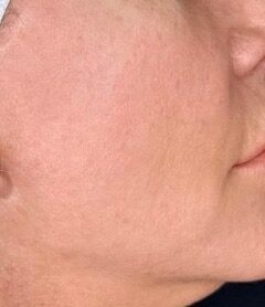 One Treatment Result after treatment