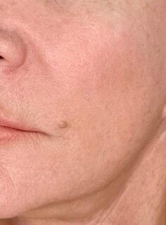 Facial Rejuvenation after treatment