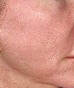 One Treatment Result before treatment
