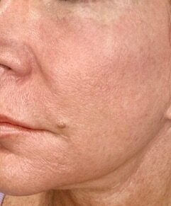 Facial Rejuvenation before treatment