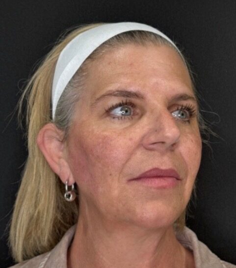 Cheek Filler after treatment