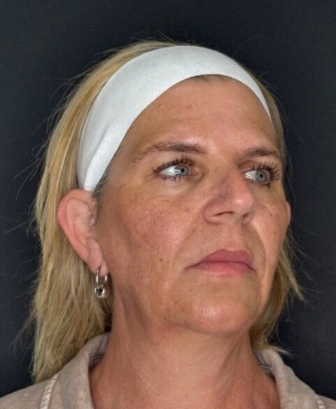 Cheek Filler before treatment