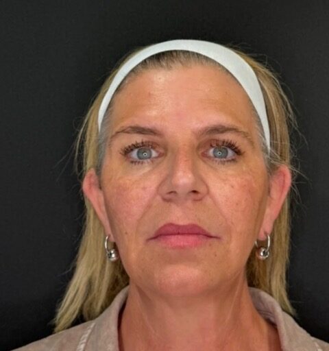 Temple Filler after treatment
