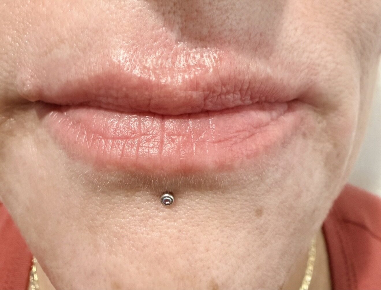 Lip Enhancement after treatment