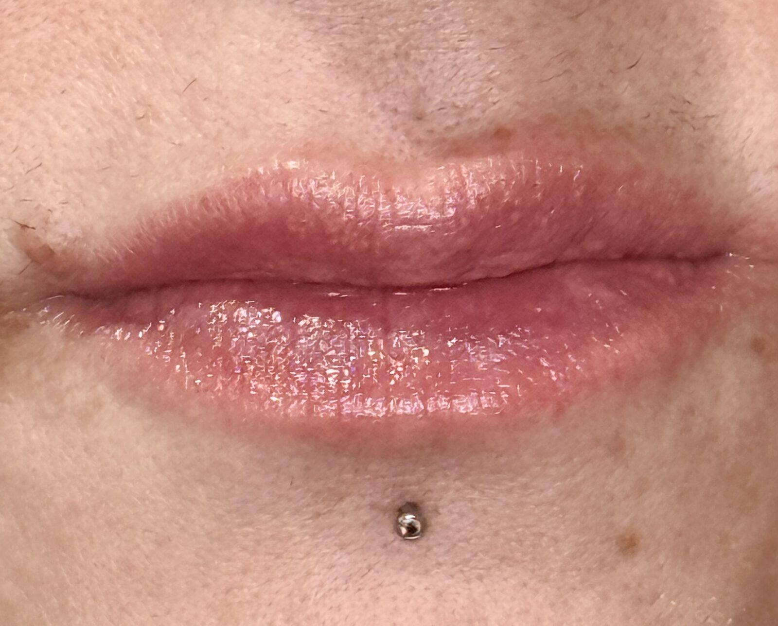 Lip Enhancement before treatment
