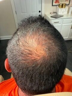 Crown before treatment