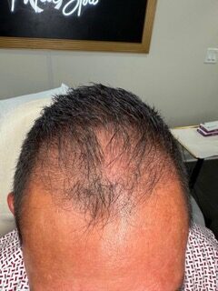 Front Hairline after treatment