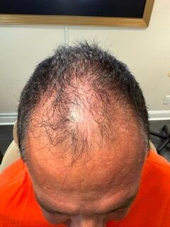 Front Hairline before treatment